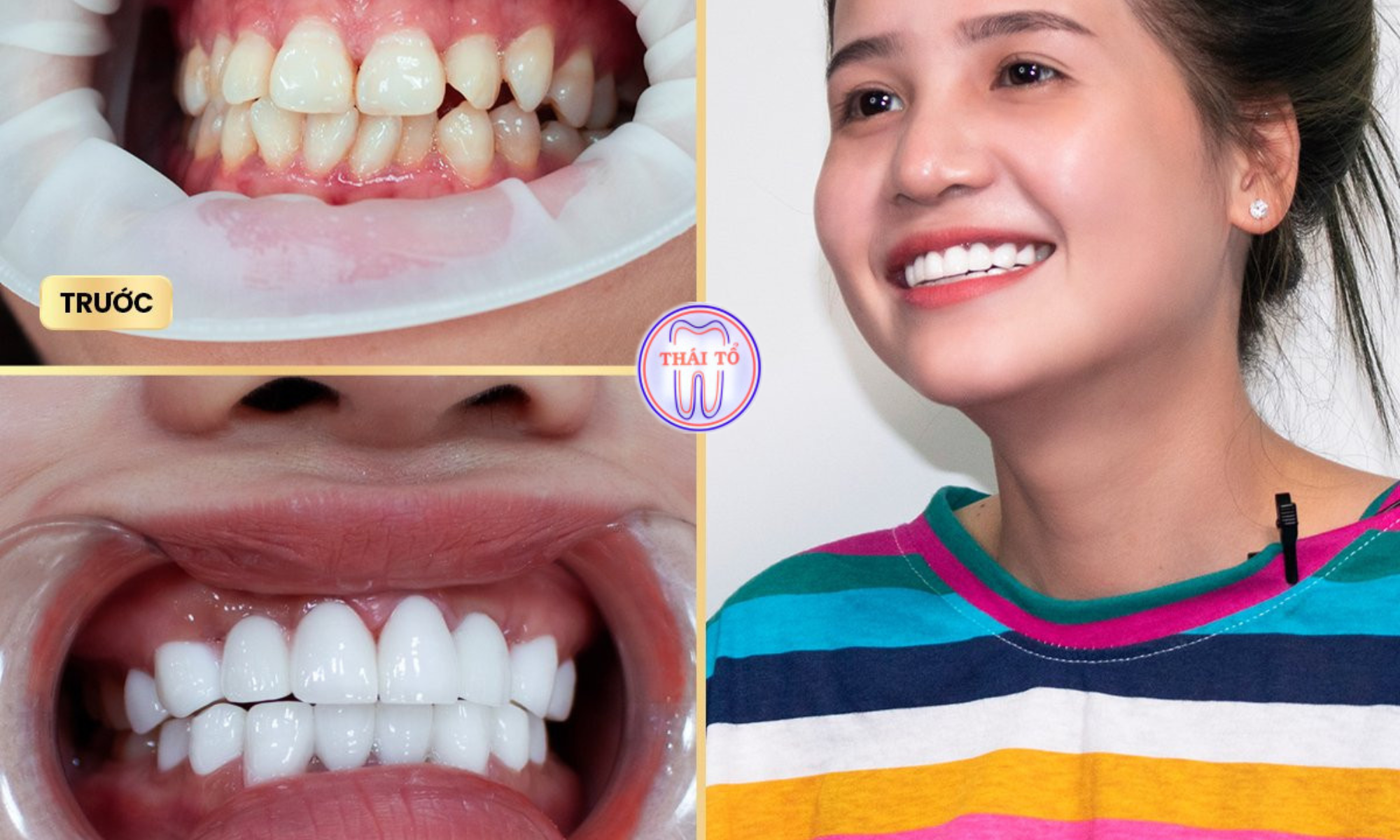 Trước và sau khi bọc răng sứ do răng nhiêm màu nặng
