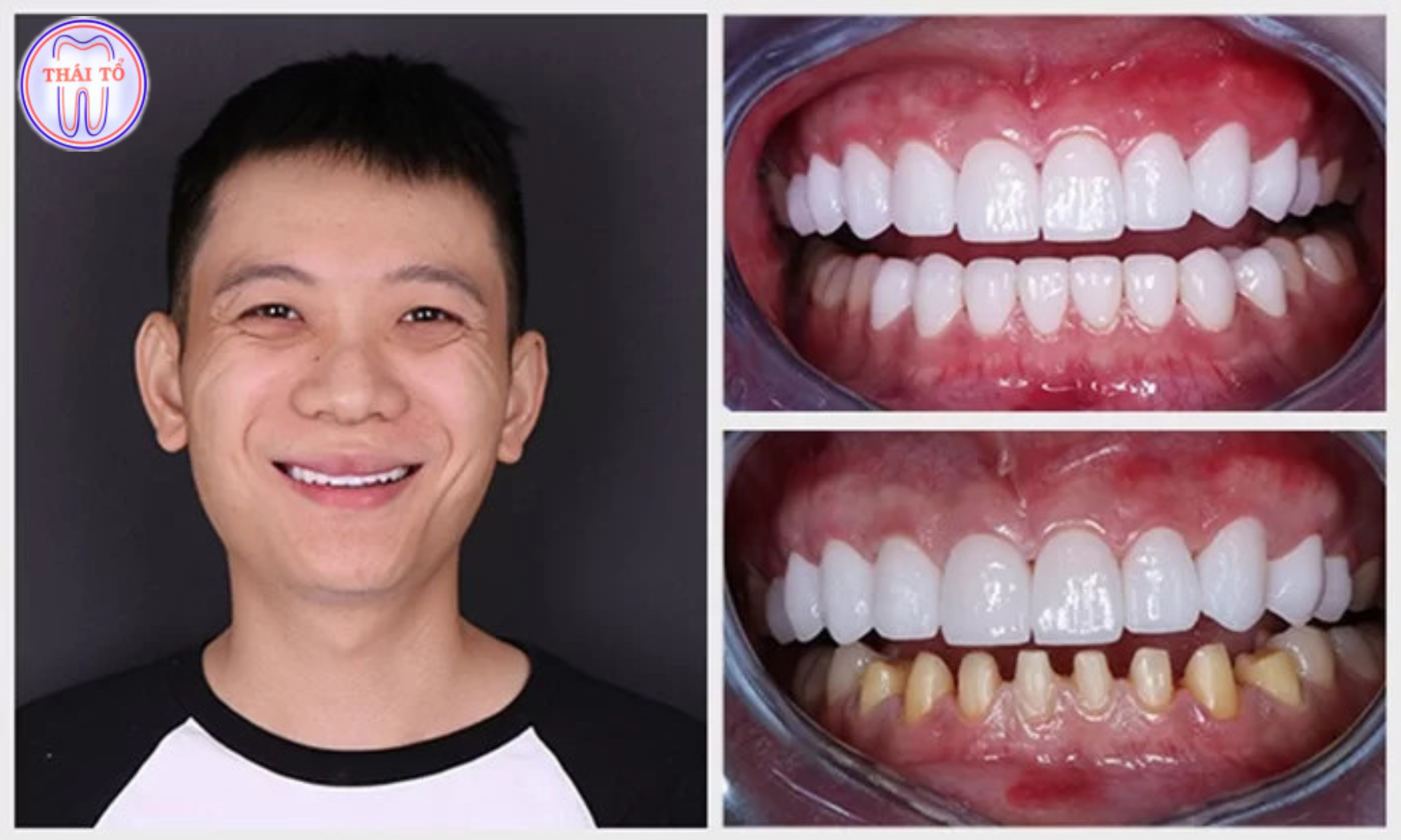 Bọc răng sứ giúp cải thiện tình trạng răng thưa, hở kẽ