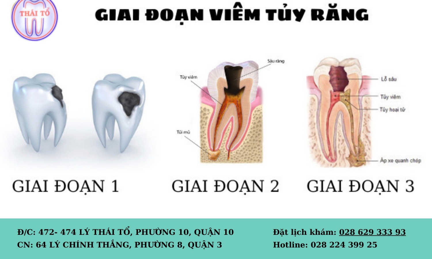 Các giai đoạn của viêm tủy răng