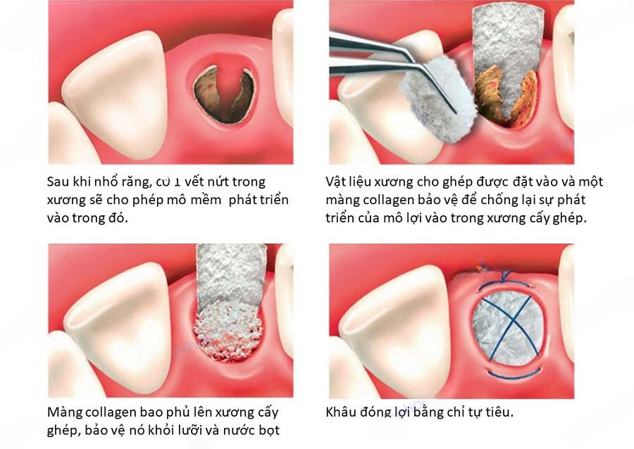 quy trình ghép xương ở răng