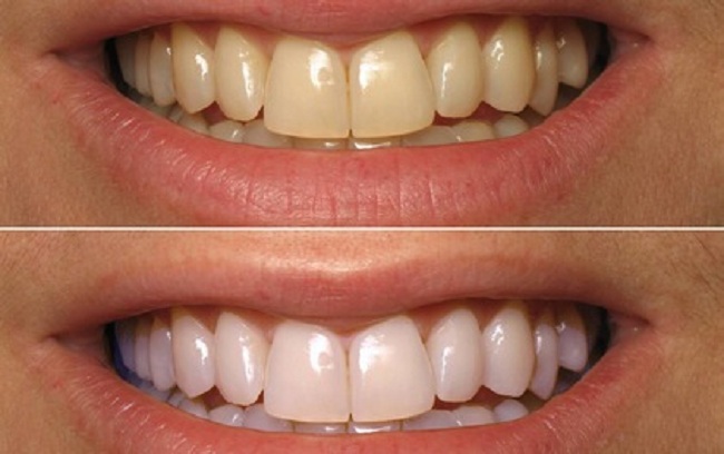 Hàm răng trước và sau khi thực hiện phương pháp tẩy trắng răng