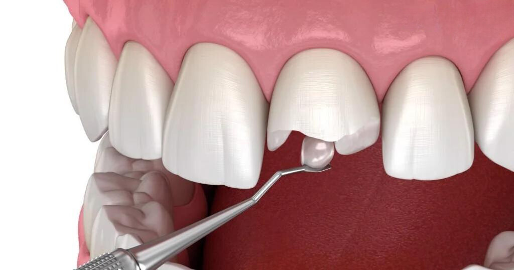 Hàn trám răng để khắc phục tình trạng răng mẻ