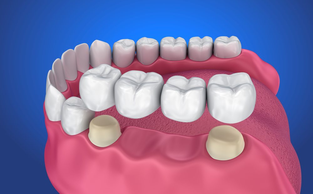 Phương pháp trồng răng bằng cầu răng