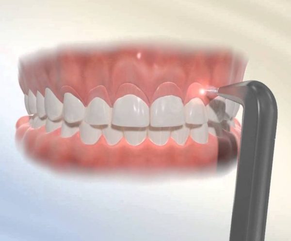 Thủ thuật cắt nướu răng là gì? phương pháp phổ biến