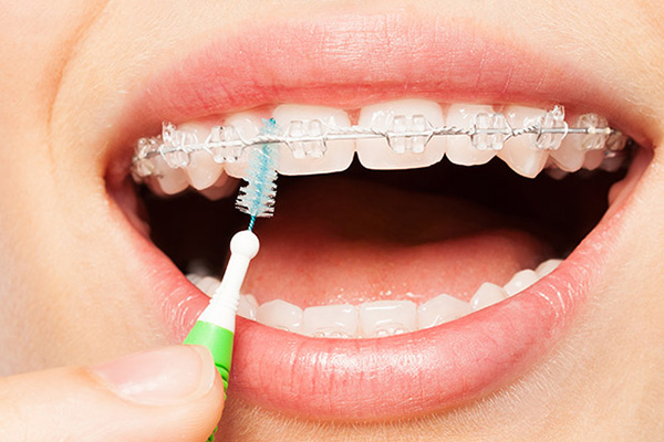 Nguyên nhân dẫn đến bung mắc cài khi niềng răng
