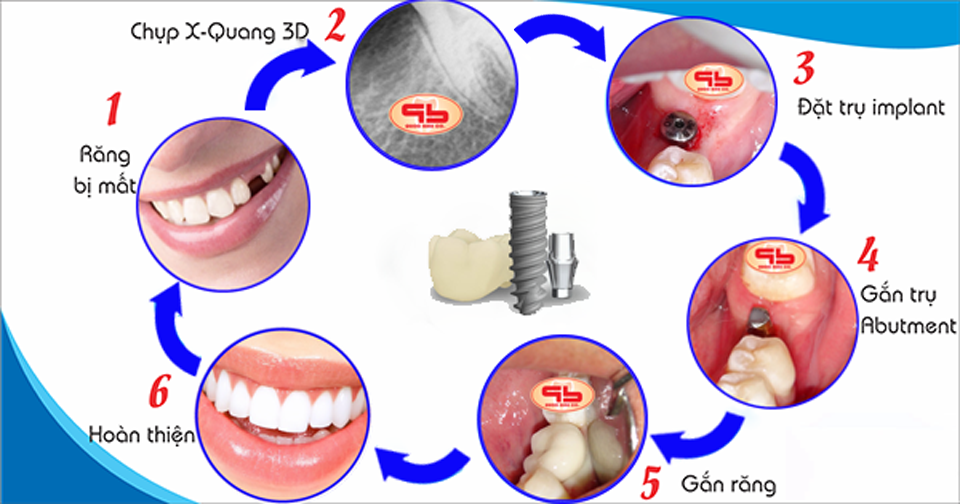 Quy trình cấy implant cho 1 răng