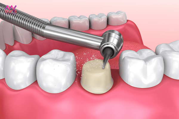 Mài răng để bọc sứ gây ra ảnh hưởng gì