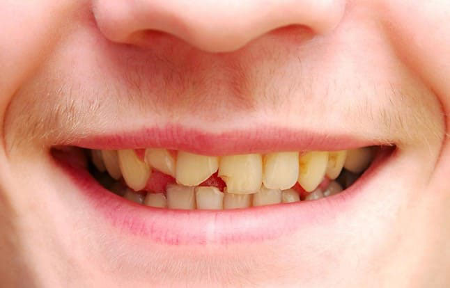 sứt mẻ răng là gì