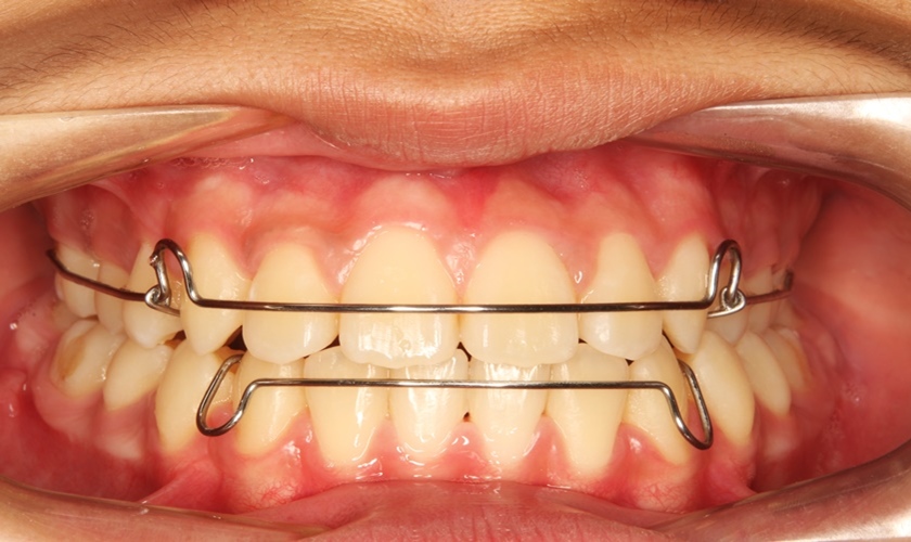 Phương pháp điều trị răng bị lệch khớp cắn