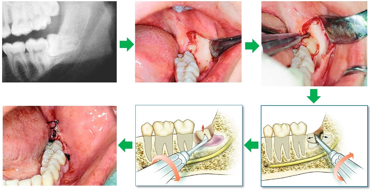 quy trình tiểu phẫu răng khôn
