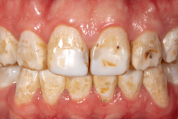 Răng bị nhiễm fluor