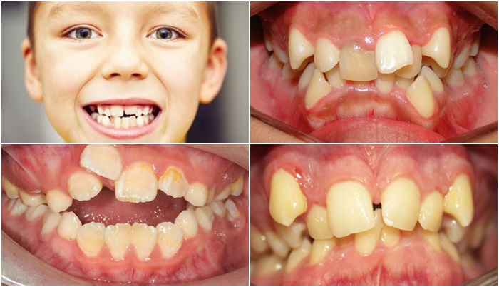 Răng bị lệch lạc ở trẻ