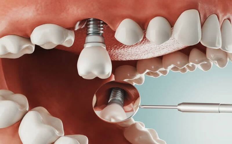 Những lựa chọn khi mất 1 răng là cấy implant