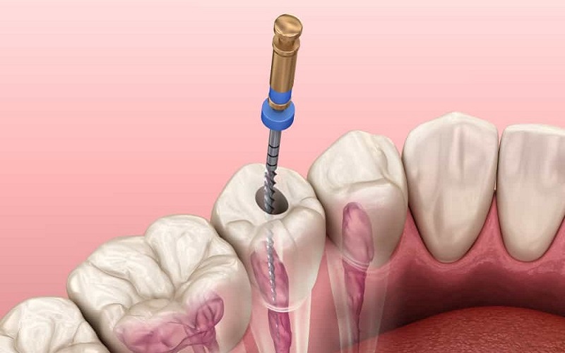 Liệu pháp điều trị tận gốc tủy răng