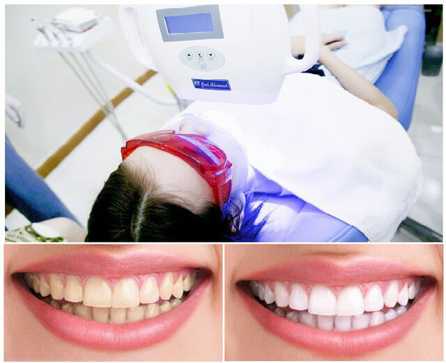Tẩy trắng răng có bị ê buốt không? 