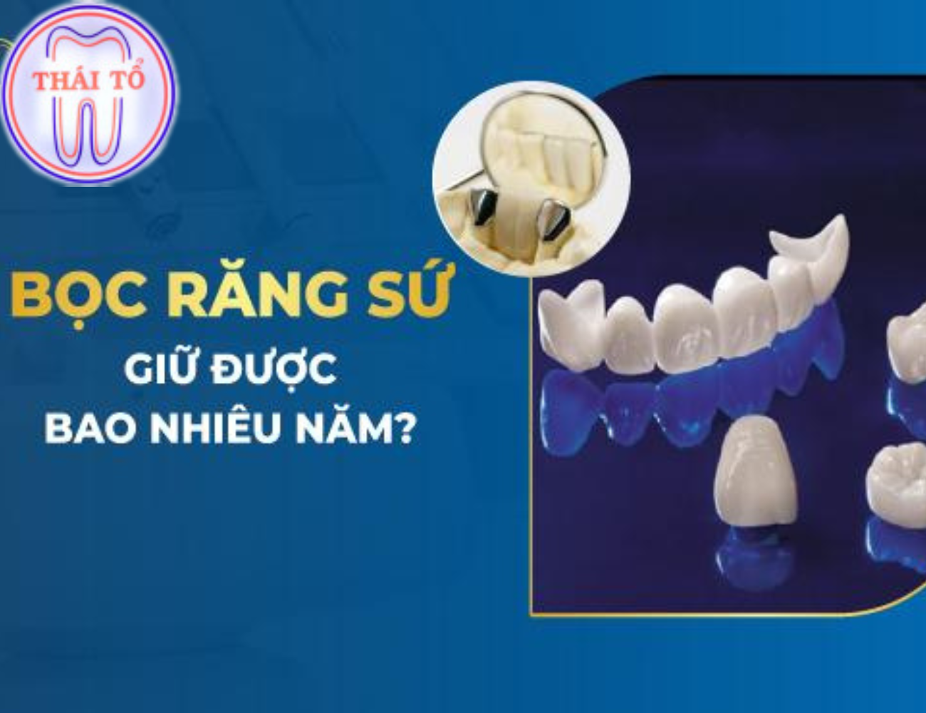 Nếu bạn biết cách vệ sinh, chăm sóc sức khỏe răng miệng thì răng sứ sẽ có tuổi thọ khá cao