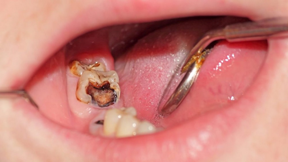 dấu hiệu và các cấp độ viêm tủy răng