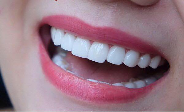 biện pháp khắc phục tình trạng thiểu sản men răng