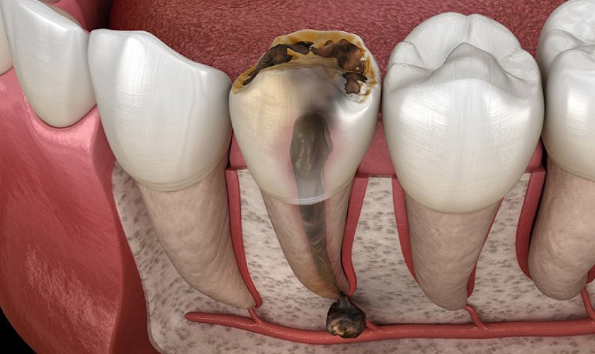 Bệnh viêm tủy răng là gì
